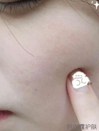 反復長痘這么多年，你需要找準痘因？