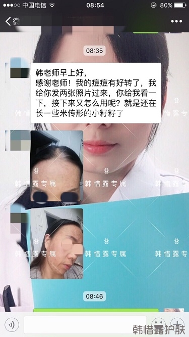 多年的粉刺痘痘，沒想到使用一周后粉刺消了這么多！