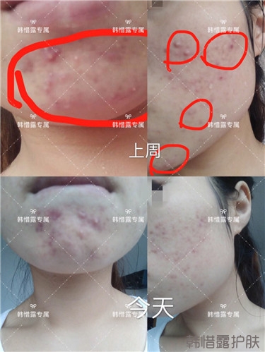 粉刺只剩一點點了，敏感肌粉刺修復(fù)，更美麗！