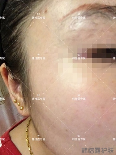 下巴長痘怎么辦？看這里徹底去掉痘痘，不再長痘了！