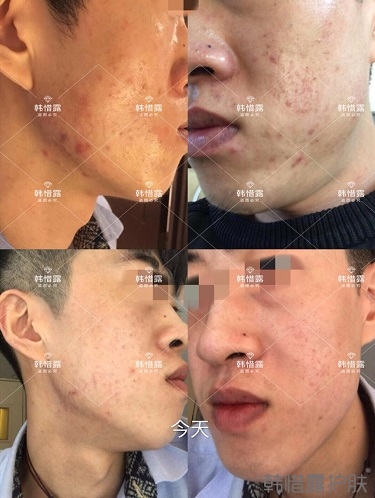 敏感肌粉刺痘痘全部消下去了，痘坑也修復平整了一部分
