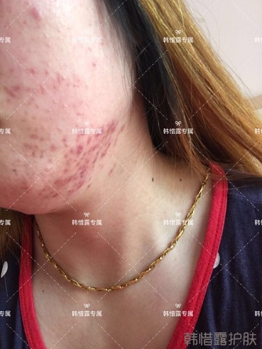 下巴長痘怎么辦？看這里徹底去掉痘痘，不再長痘了！