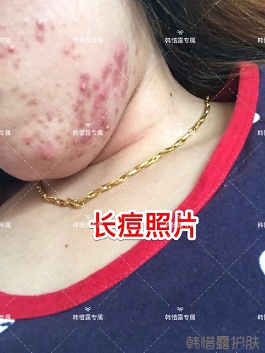 下巴長痘怎么辦？看這里徹底去掉痘痘，不再長痘了！