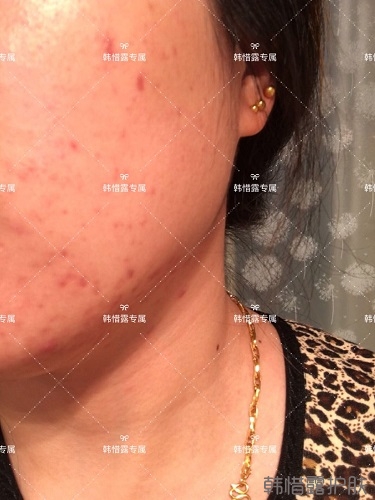 下巴長痘怎么辦？看這里徹底去掉痘痘，不再長痘了！