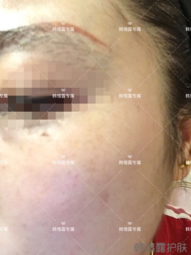 下巴長痘怎么辦？看這里徹底去掉痘痘，不再長痘了！