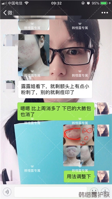 粉刺只剩一點點了，敏感肌粉刺修復(fù)，更美麗！
