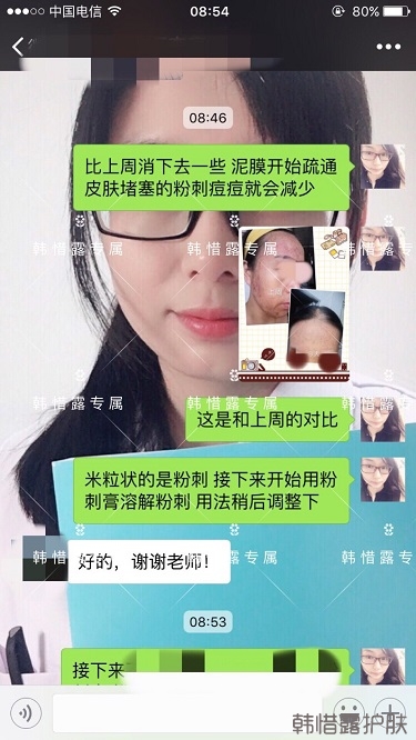 多年的粉刺痘痘，沒想到使用一周后粉刺消了這么多！