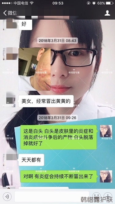 膿包結節發硬痘痘全消了，帥哥開心的來反饋了！
