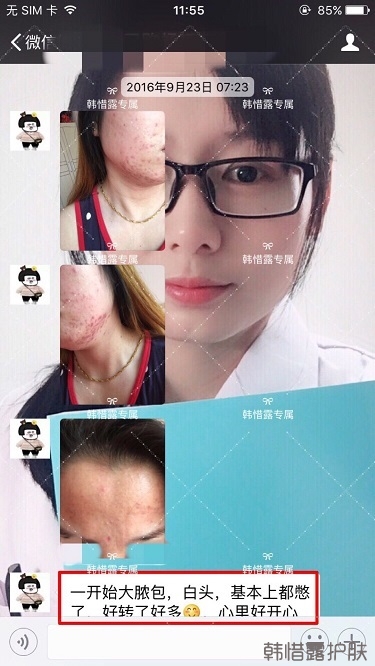 下巴長痘怎么辦？看這里徹底去掉痘痘，不再長痘了！