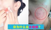 臉上長(zhǎng)痘痘是什么原因？請(qǐng)問(wèn)主要是什么原因呢？