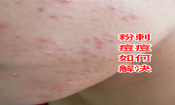 臉上長(zhǎng)粉刺去粉刺的方法!不可錯(cuò)過的去痘痘粉刺變美機(jī)會(huì)！