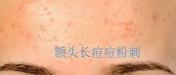 額頭長痘，臉頰長痘痘粉刺，就這樣恢復(fù)嫩白肌膚！