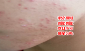 臉上長粉刺去粉刺的方法!不可錯過的去痘痘粉刺變美機(jī)會！