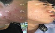 敏感肌粉刺痘痘全部消下去了，痘坑也修復(fù)平整了很多