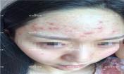 臉上長(zhǎng)粉刺怎樣去掉？醫(yī)院都沒(méi)搞定韓惜露幫我搞定了，超級(jí)開(kāi)心！【視頻】